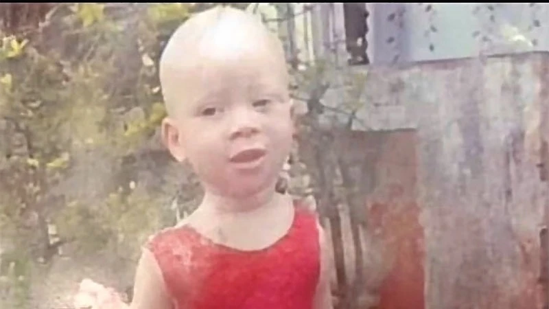 Child with albinism Asimwe Nobath (2).