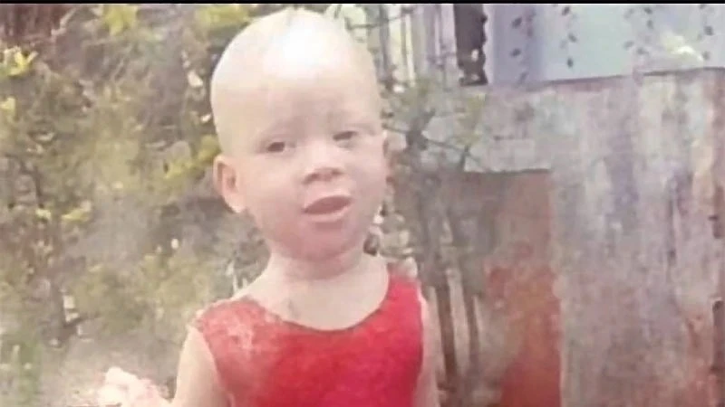 Child with albinism Asimwe Nobath (2).