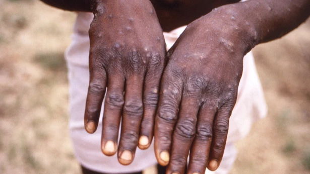 Mpox disease.