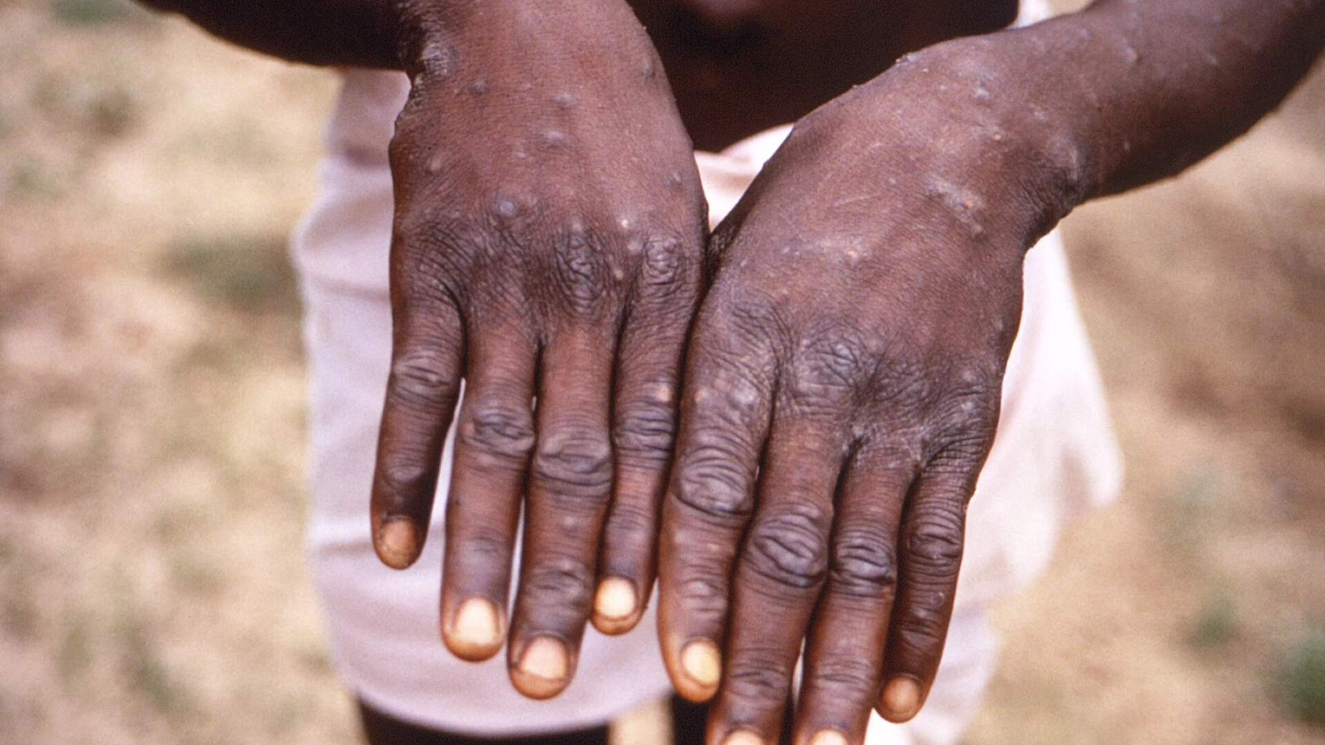 mpox patient