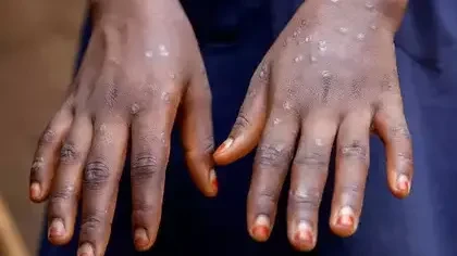 mpox patient