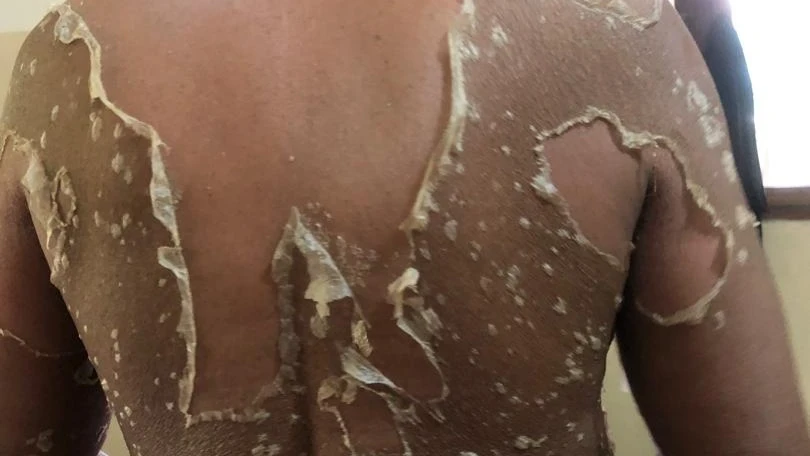 Ugonjwa wa psoriasis ulivyoathiri ngozi ya mwili