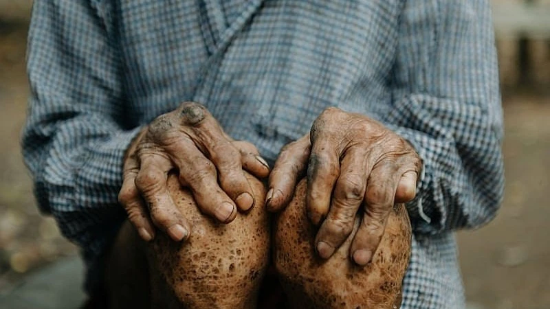 Leprosy is a chronic infectious disease that is curable, early treatment can prevent disability