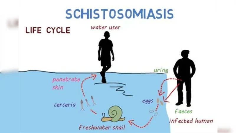 Schistosomiasis.